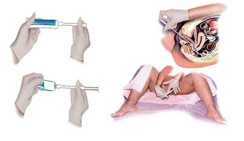 huong-dan-su-dung-vien-dat-phu-khoa-4