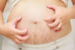 Bầu mấy tháng thì bôi kem trị rạn da? Lời khuyên từ chuyên gia