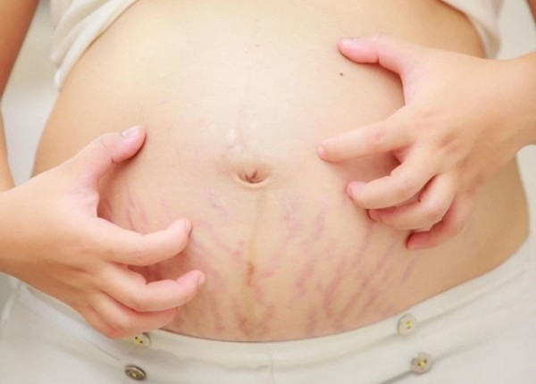 Bầu mấy tháng thì bôi kem trị rạn da? Lời khuyên từ chuyên gia