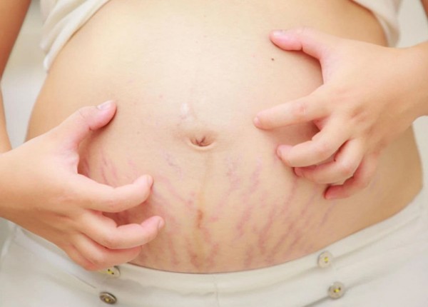 Rạn da khi mang thai có hết không? Giải pháp từ Beautanicae Crème Onctueuse Vergetures