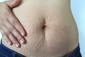 Rạn da sau sinh có tự hết không? Giải pháp hiệu quả, an toàn