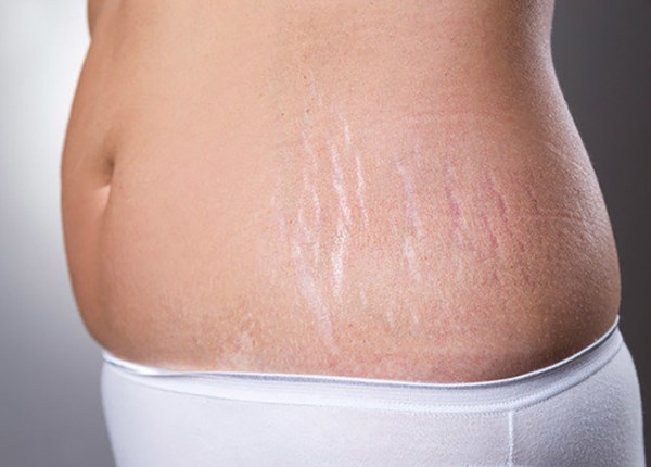 Ăn gì để hạn chế rạn da sau sinh? Gợi ý từ bác sĩ