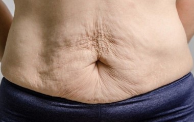 Hướng dẫn cách trị rạn sau sinh hiệu quả từ chuyên gia	