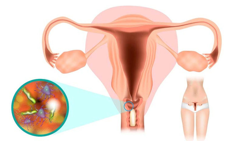 dieu-tri-dut-diem-viem-am-dao-1