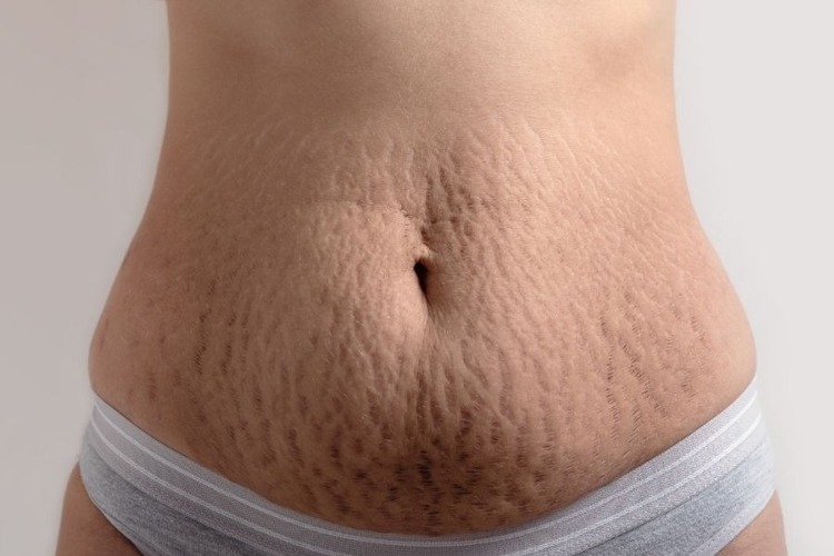 phuc-hoi-ran-da-bung-sau-sinh-1