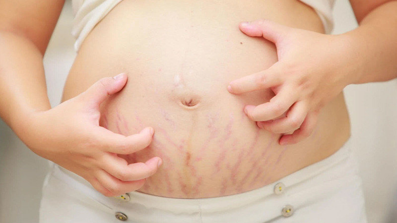 vung-de-bi-ran-da-khi-mang-thai-3